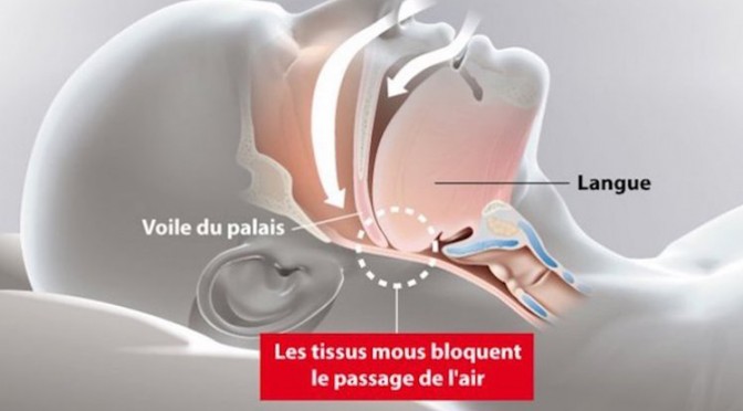 2_pneumo_apnee_du_sommeil