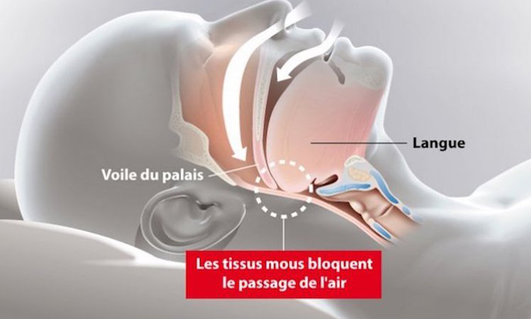 2_pneumo_apnee_du_sommeil
