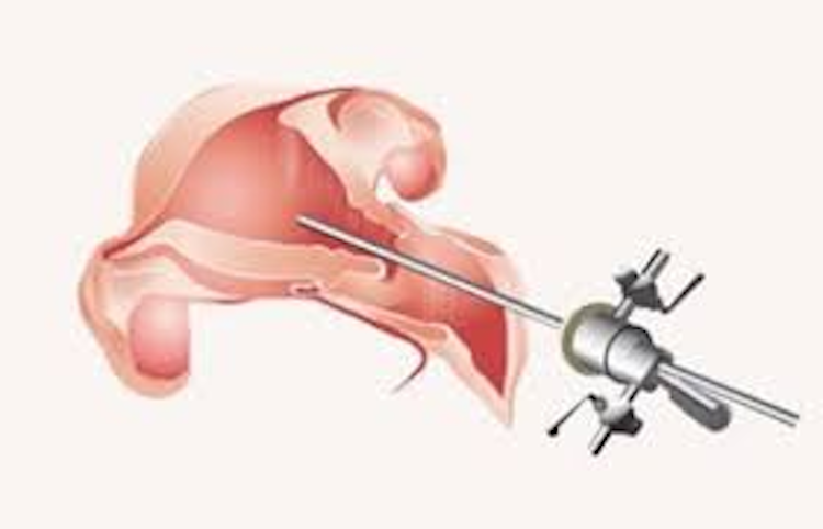 Hysteroscopies