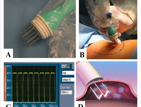 Electrochemotherapie: een nieuwe techniek voor de behandeling van cutane metastasen