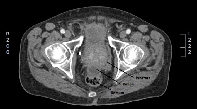 Prostaatkanker: het Chirec innoveert met een originele radiotherapeutische benadering