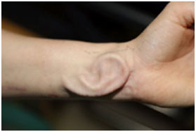 Une nouvelle méthode de reconstruction de l’oreille à l’aide d’une oreille implantée dans l’avant-bras