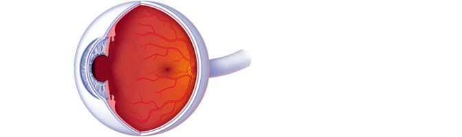 Fakische oogimplantaten of ICL