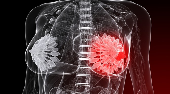 Borstkanker: de Oncoplastie in dienst van de Esthetiek