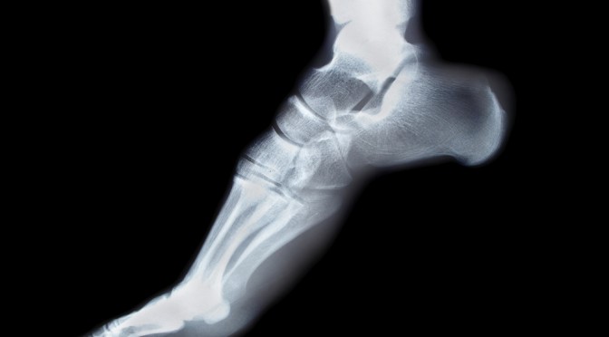 Pathologie du pied et de la cheville : toutes les données actualisées