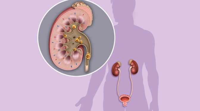 Lithiasis: naar een multidisciplinaire aanpak