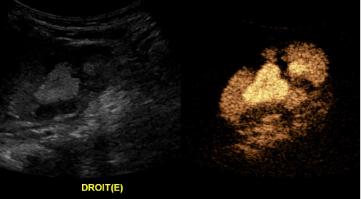 Implantation de la cystographie échographique (cystosonographie) pour le diagnostic du reflux vésico-urétéral chez l’enfant à l’Hôpital Delta