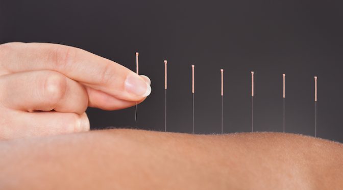 Douleur chronique ou aigüe: l’acupuncture se déploie sur le site Delta du Chirec