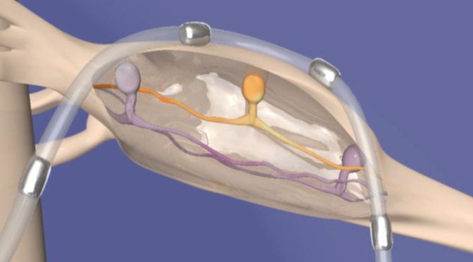 Algoneurodystrophie: la stimulation du ganglion dorsal comme seul traitement?